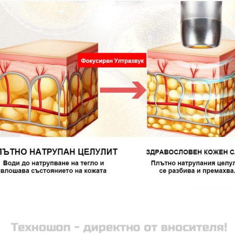 Лифтинг и подмладяване на кожата - апарат V-Max Hifu – снимка 7